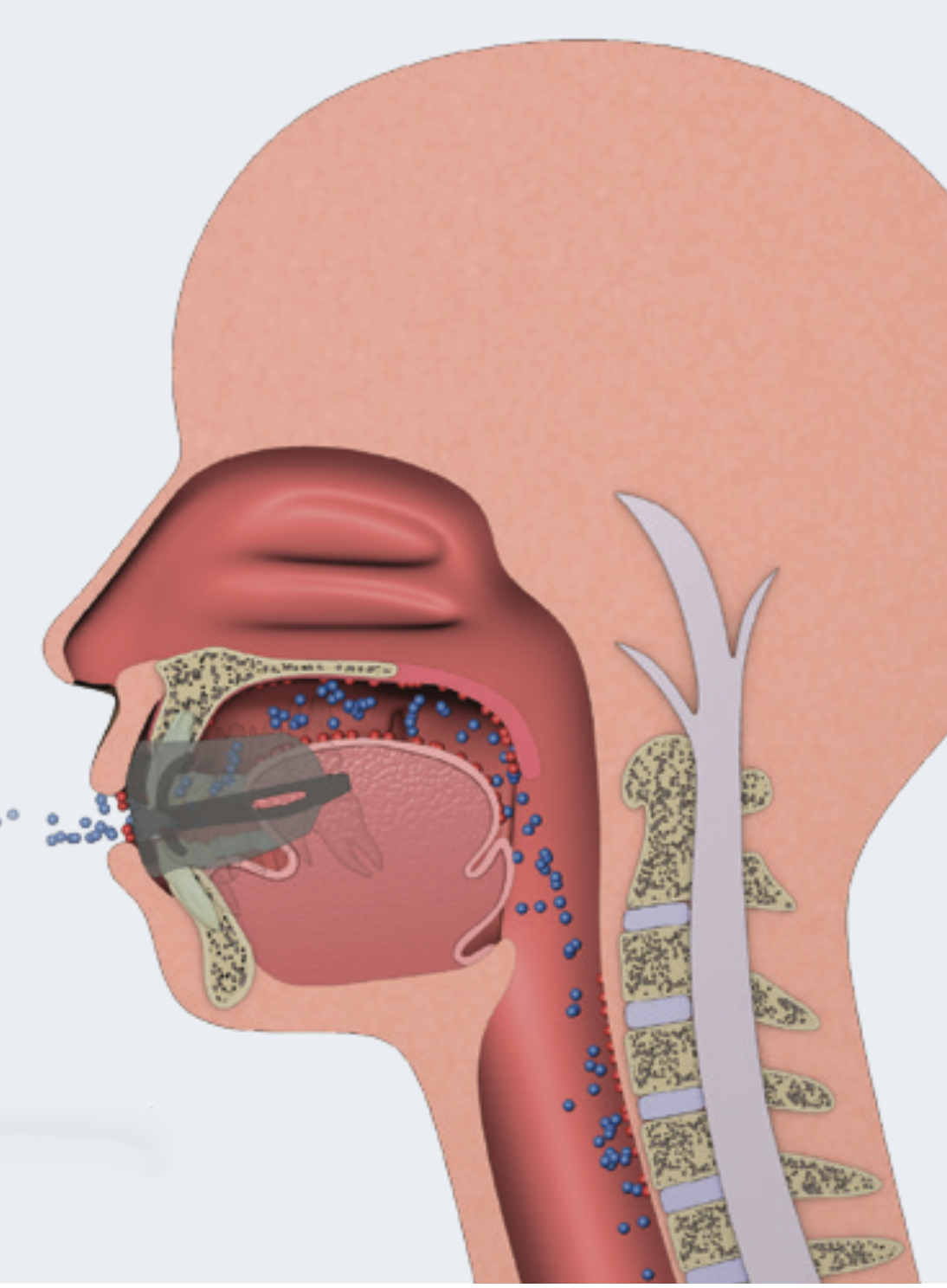 Máng chống ngáy và điều chỉnh đường thở Myosa